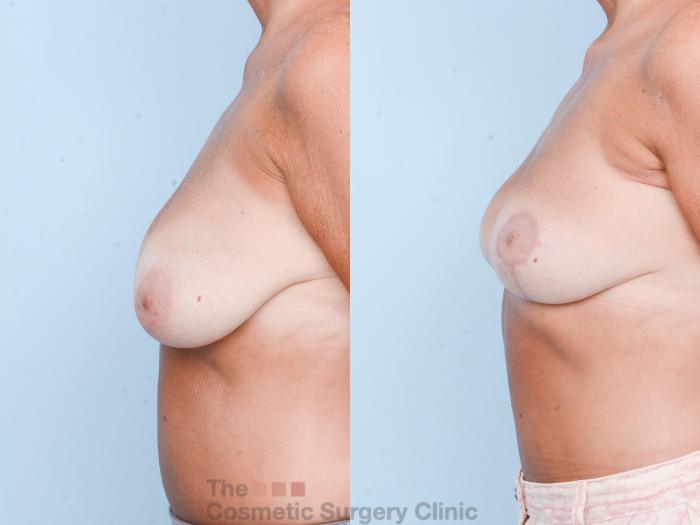 Before & After Breast Lift Case 818 Left Side View in Waterloo, Ontario