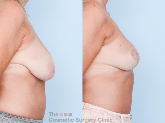 Before & After Breast Lift Case 818 Right Side View in Waterloo, Ontario