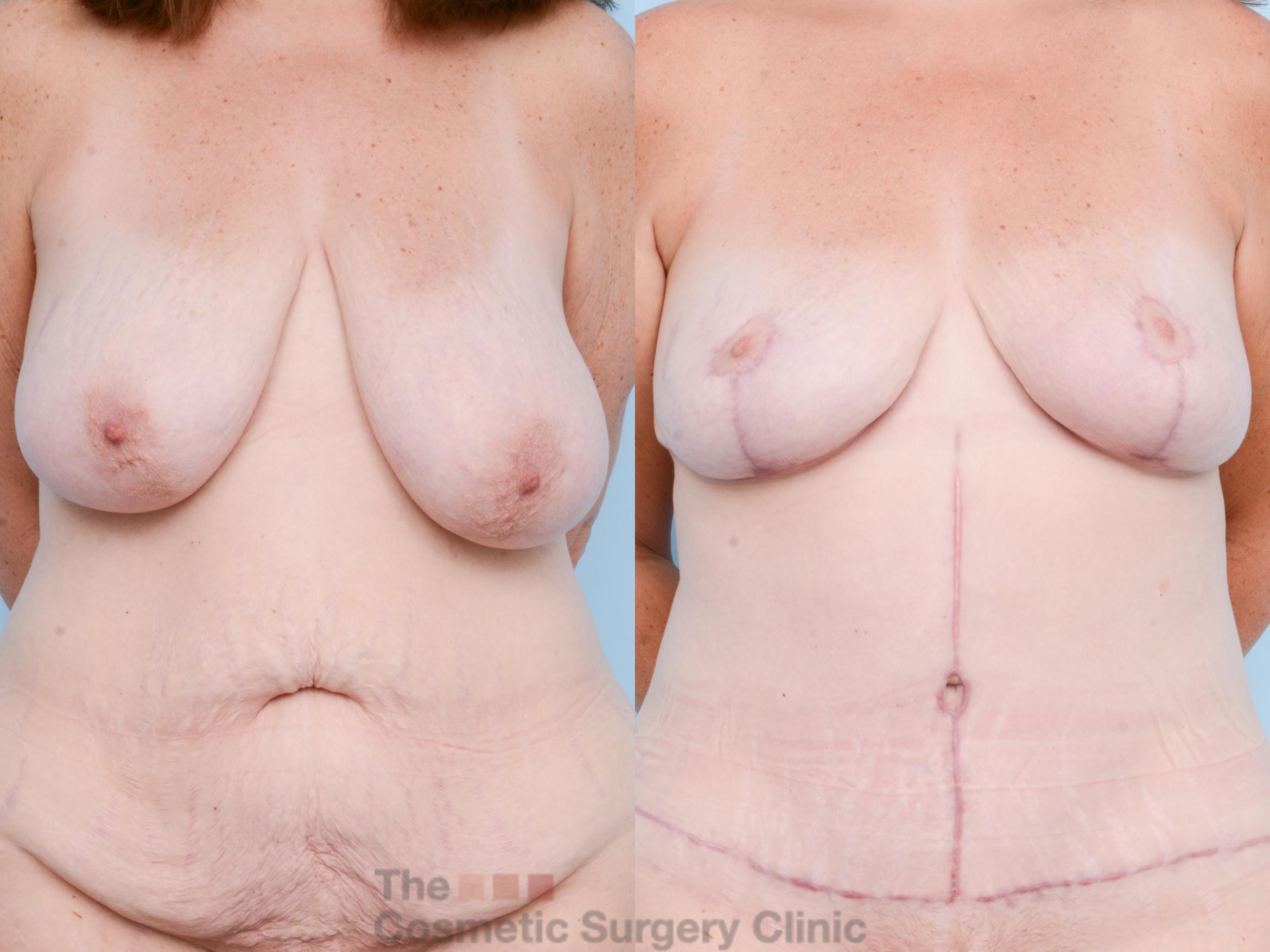 Before & After Breast Reduction Case 824 Front View in Waterloo, Ontario