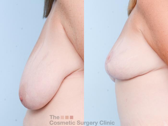 Before & After Breast Reduction Case 824 Left Side View in Waterloo, Ontario