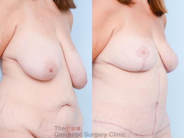 Before & After Breast Reduction Case 824 Right Oblique View in Waterloo, Ontario