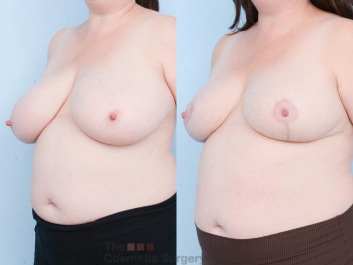 Before & After Breast Lift Case 827 Left Oblique View in Waterloo, Ontario