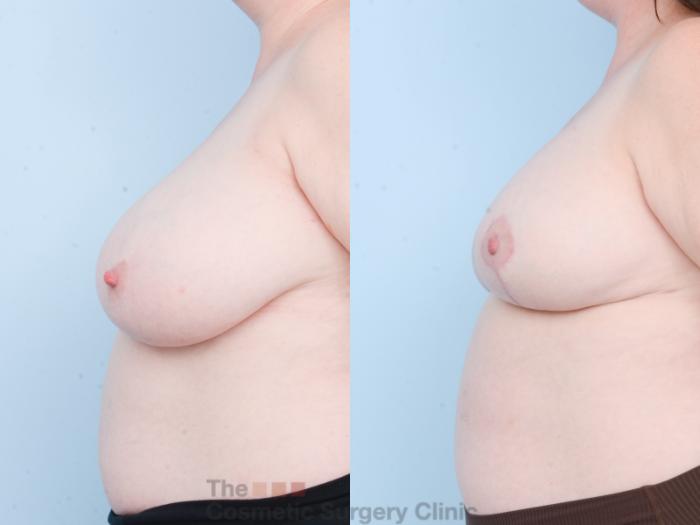 Before & After Breast Lift Case 827 Left Side View in Waterloo, Ontario