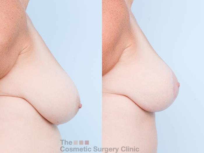 Before & After Breast Lift Case 831 Right Side View in Waterloo, Ontario