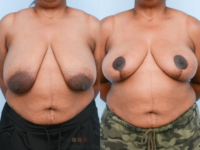 Before & After Breast Lift Case 840 Front View in Waterloo, Ontario