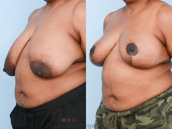 Before & After Breast Lift Case 840 Left Oblique View in Waterloo, Ontario