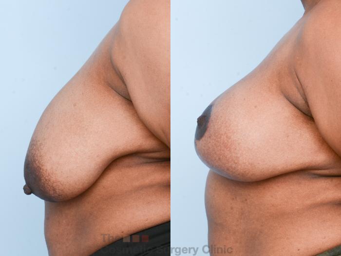 Before & After Breast Lift Case 840 Left Side View in Waterloo, Ontario