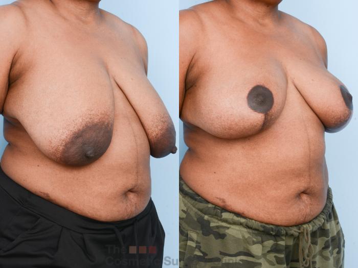 Before & After Breast Lift Case 840 Right Oblique View in Waterloo, Ontario
