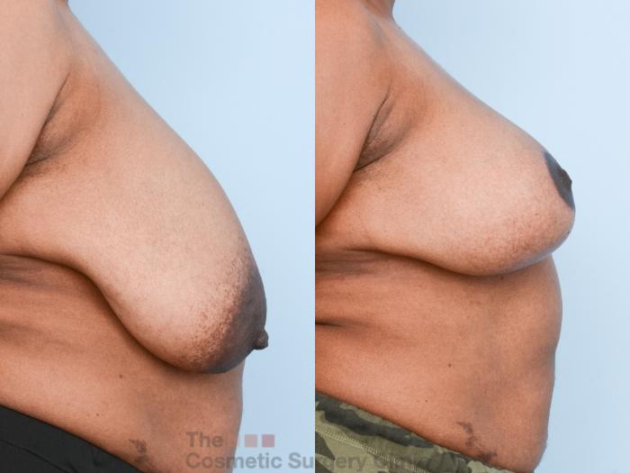 Before & After Breast Lift Case 840 Right Side View in Waterloo, Ontario
