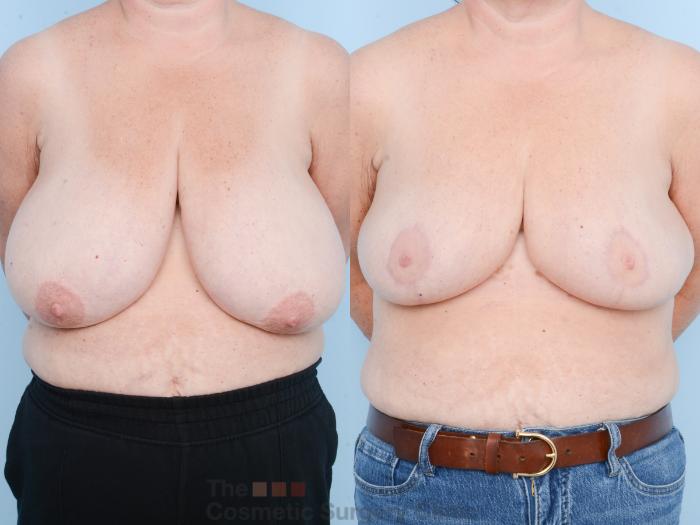 Before & After Breast Lift Case 845 Front View in Waterloo, Ontario