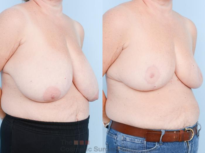 Before & After Breast Lift Case 845 Right Oblique View in Waterloo, Ontario