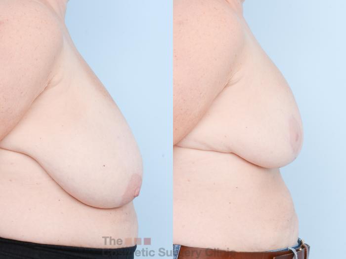 Before & After Breast Lift Case 845 Right Side View in Waterloo, Ontario
