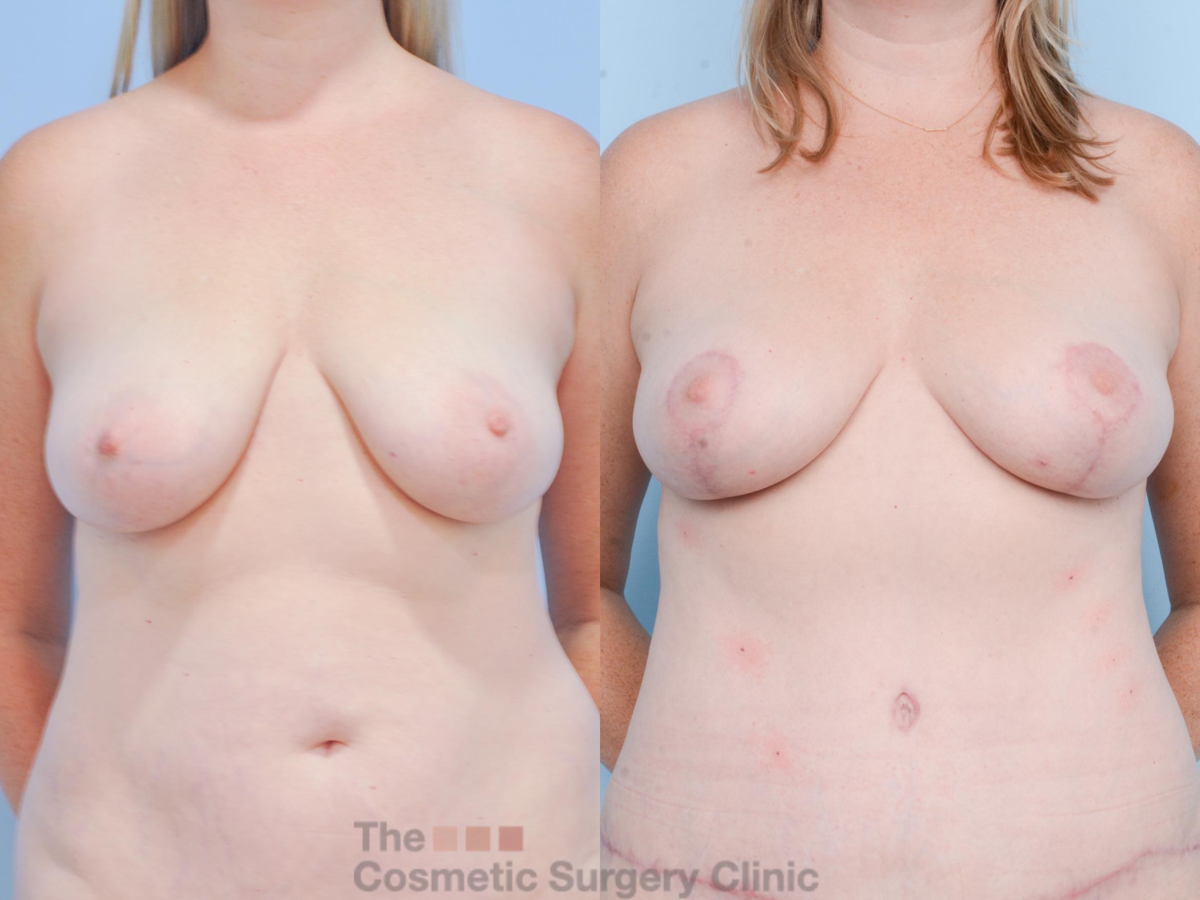 Before & After Breast Fat Grafting (No Implant) Case 853 Front View in Waterloo, Ontario
