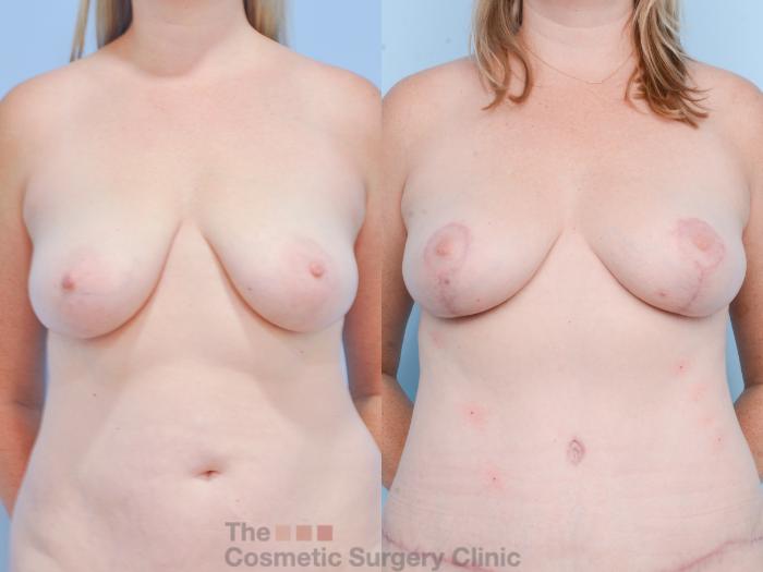 Before & After Breast Fat Grafting (No Implant) Case 853 Front View in Waterloo, Ontario