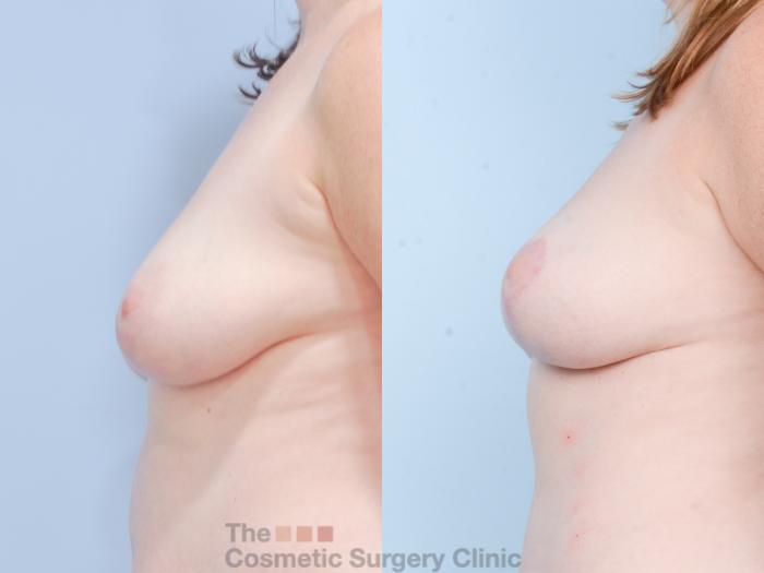 Before & After Breast Fat Grafting (No Implant) Case 853 Left Side View in Waterloo, Ontario