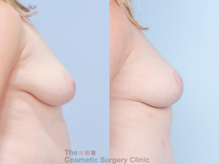 Before & After Breast Fat Grafting (No Implant) Case 853 Right Side View in Waterloo, Ontario