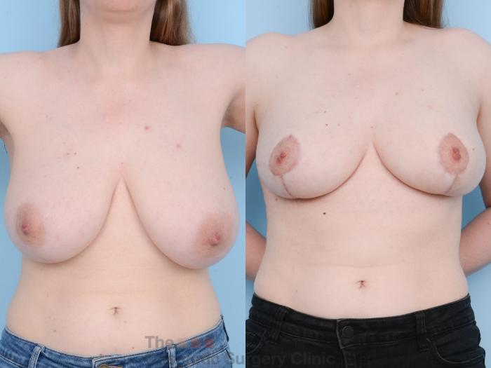 Before & After Breast Lift Case 863 Front View in Waterloo, Ontario