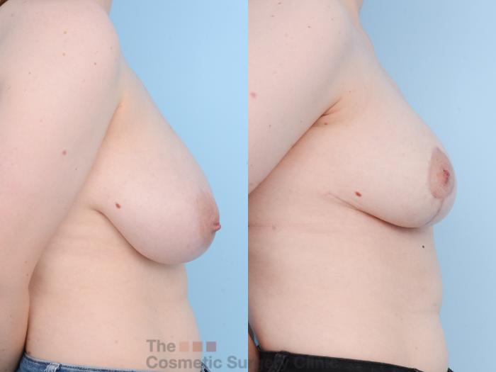 Before & After Breast Lift Case 863 Right Side View in Waterloo, Ontario