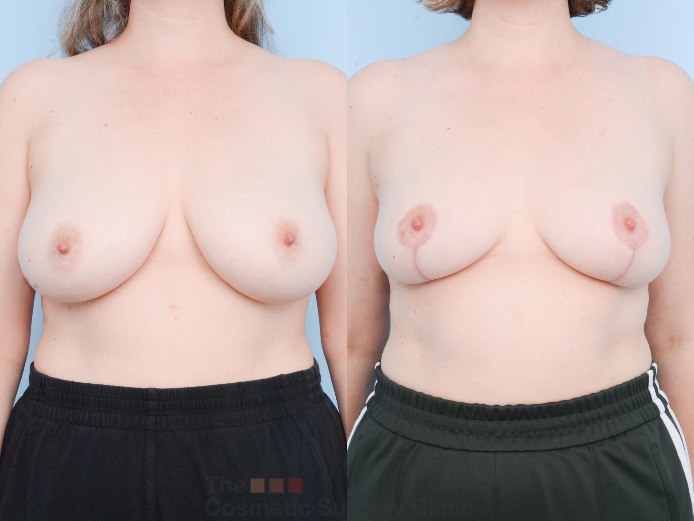 Before & After Breast Lift Case 865 Front View in Waterloo, Ontario