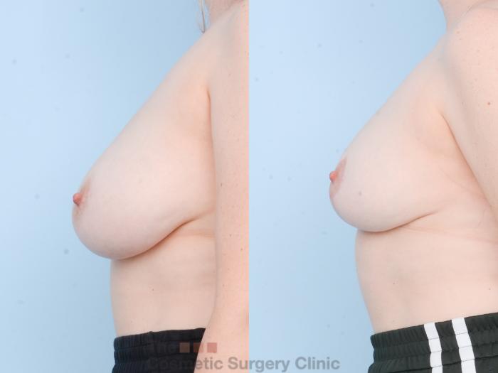 Before & After Breast Lift Case 865 Left Side View in Waterloo, Ontario