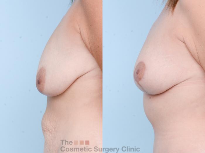 Before & After Breast Lift Case 874 Left Side View in Waterloo, Ontario