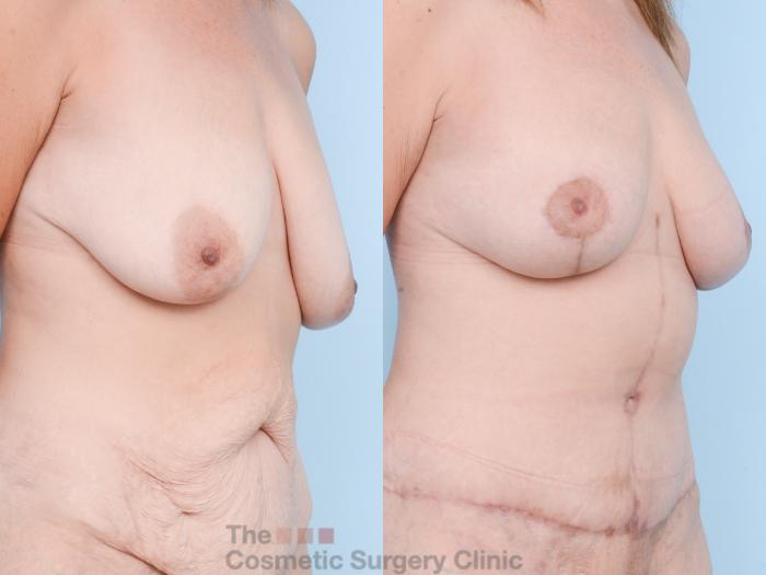 Before & After Breast Lift Case 874 Right Oblique View in Waterloo, Ontario