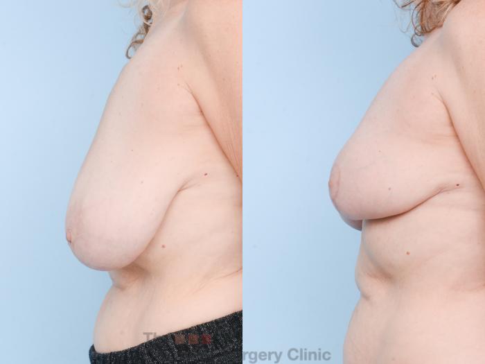 Before & After Breast Lift Case 877 Left Side View in Waterloo, Ontario