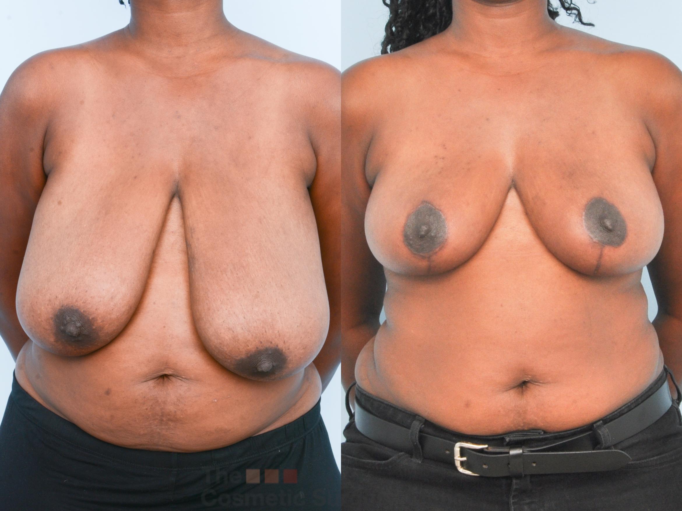 Before & After Breast Lift Case 888 Front View in Waterloo, Ontario