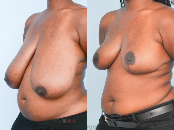 Before & After Breast Lift Case 888 Left Oblique View in Waterloo, Ontario