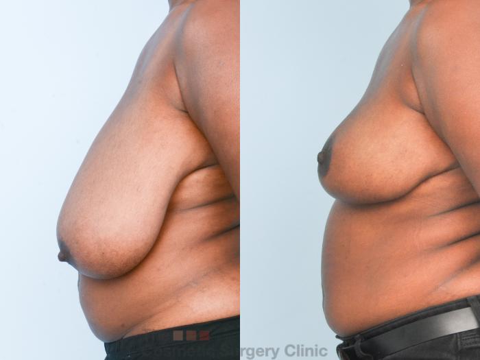 Before & After Breast Lift Case 888 Left Side View in Waterloo, Ontario