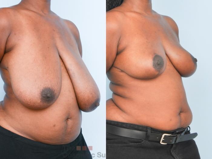 Before & After Breast Lift Case 888 Right Oblique View in Waterloo, Ontario