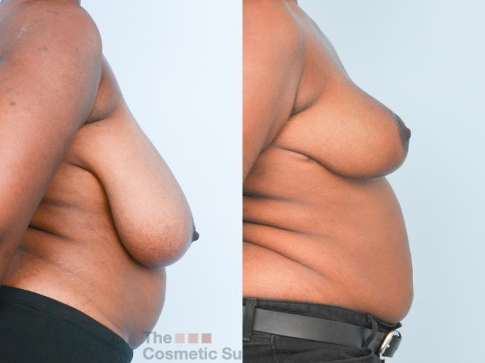 Before & After Breast Lift Case 888 Right Side View in Waterloo, Ontario