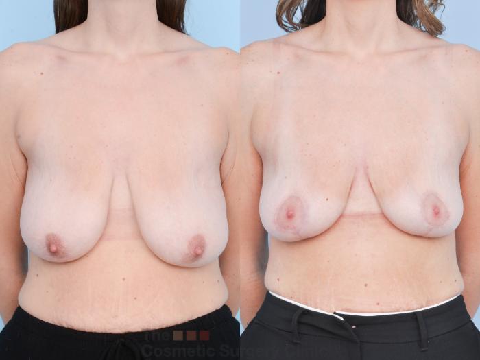 Before & After Breast Lift Case 898 Front View in Waterloo, Ontario