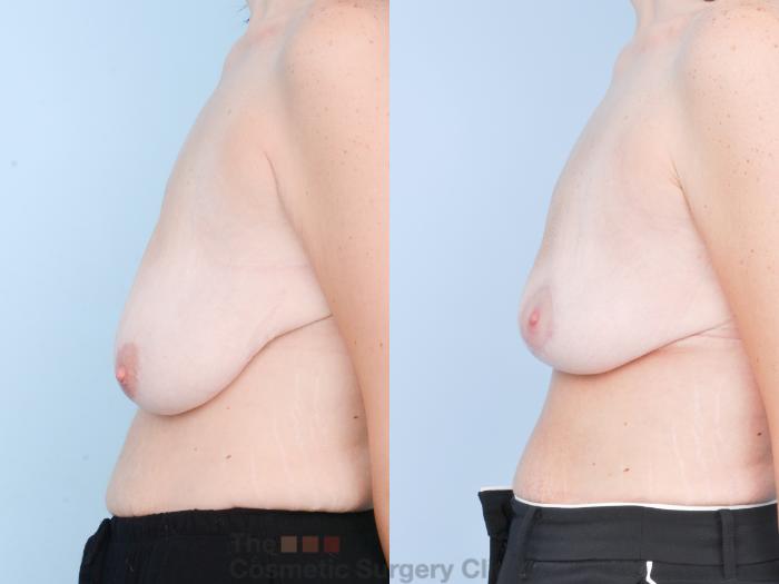 Before & After Breast Lift Case 898 Left Side View in Waterloo, Ontario