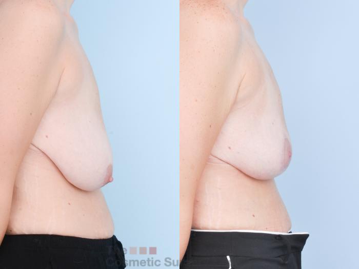 Before & After Breast Lift Case 898 Right Side View in Waterloo, Ontario