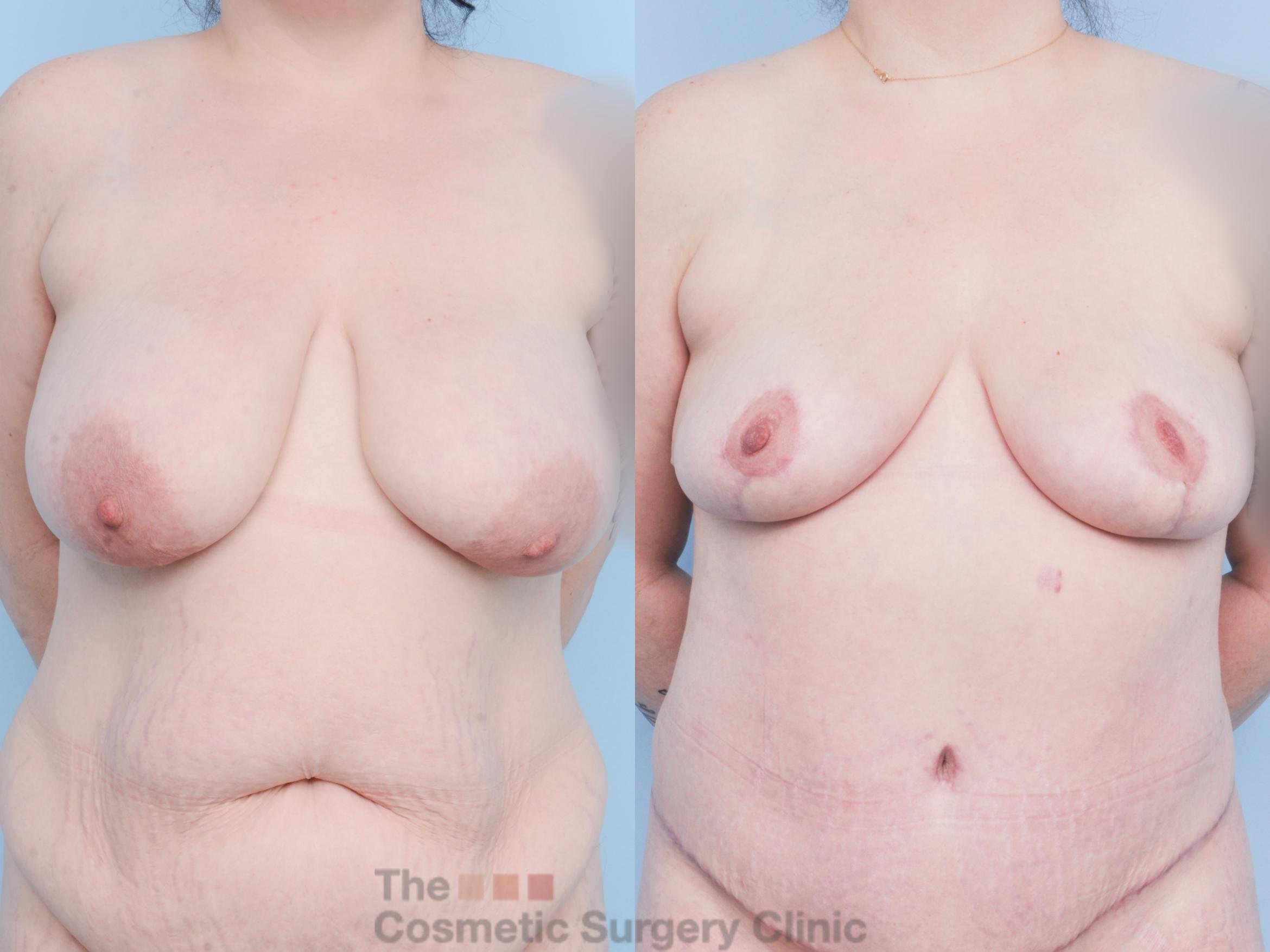 Before & After Breast Lift Case 904 Front View in Waterloo, Ontario