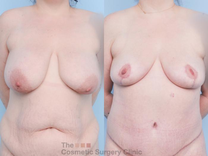 Before & After Breast Lift Case 904 Front View in Waterloo, Ontario