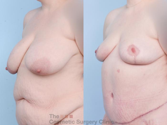 Before & After Breast Lift Case 904 Left Oblique View in Waterloo, Ontario