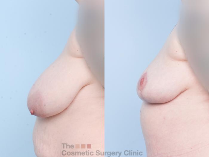 Before & After Breast Lift Case 904 Left Side View in Waterloo, Ontario