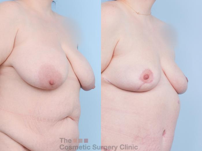 Before & After Breast Lift Case 904 Right Oblique View in Waterloo, Ontario