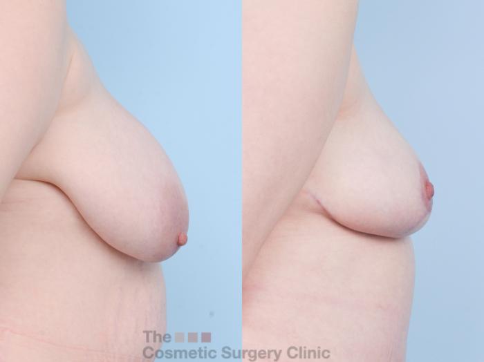 Before & After Breast Lift Case 904 Right Side View in Waterloo, Ontario