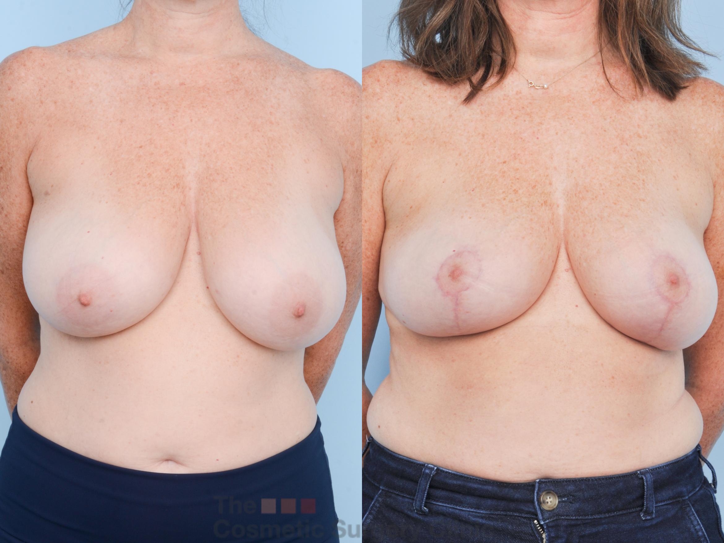 Before & After Breast Lift Case 906 Front View in Waterloo, Ontario