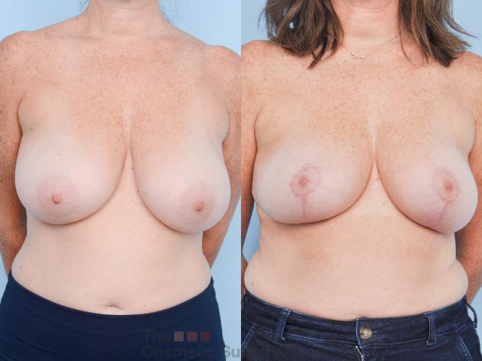 Before & After Breast Lift Case 906 Front View in Waterloo, Ontario