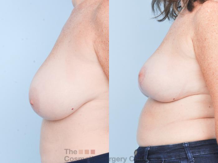 Before & After Breast Lift Case 906 Left Side View in Waterloo, Ontario