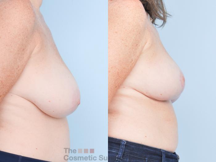 Before & After Breast Lift Case 906 Right Side View in Waterloo, Ontario