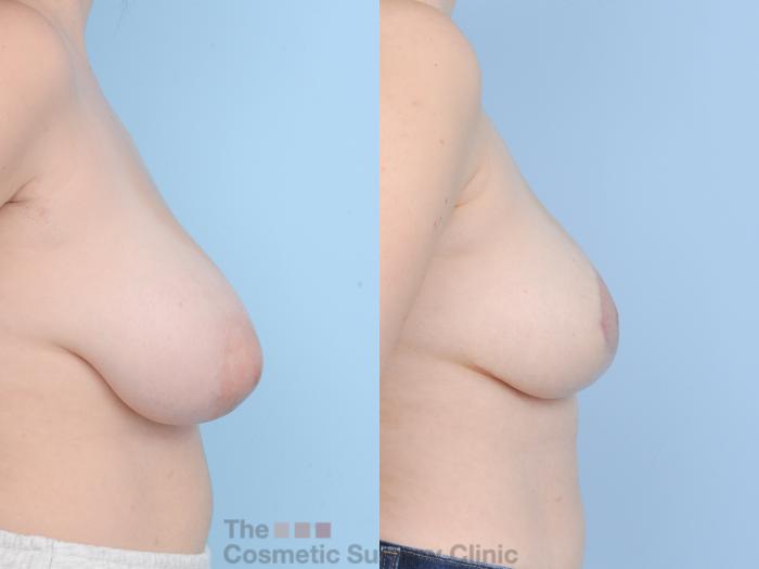 Before & After Breast Lift Case 908 Right Side View in Waterloo, Ontario