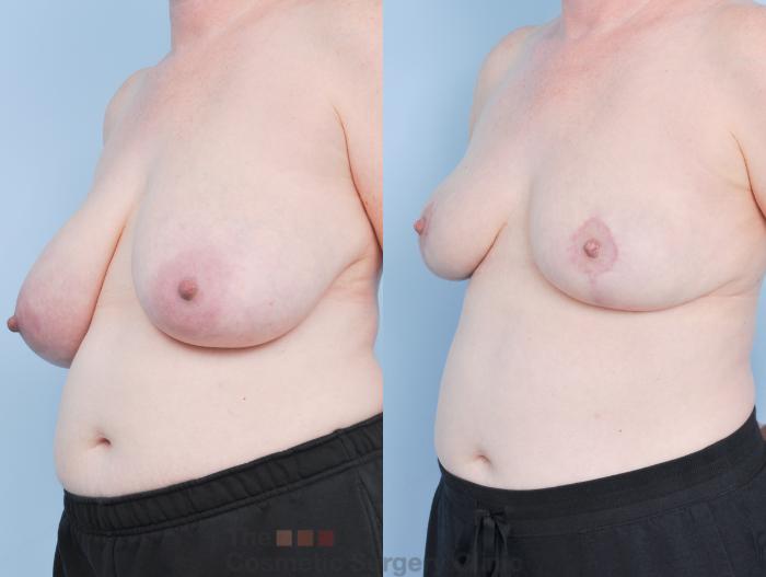 Before & After Breast Lift Case 920 Left Oblique View in Waterloo, Ontario