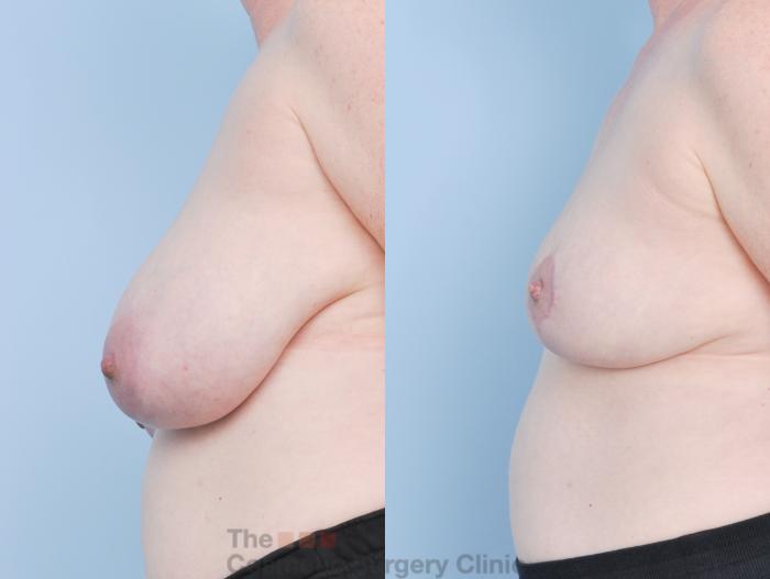 Before & After Breast Lift Case 920 Left Side View in Waterloo, Ontario
