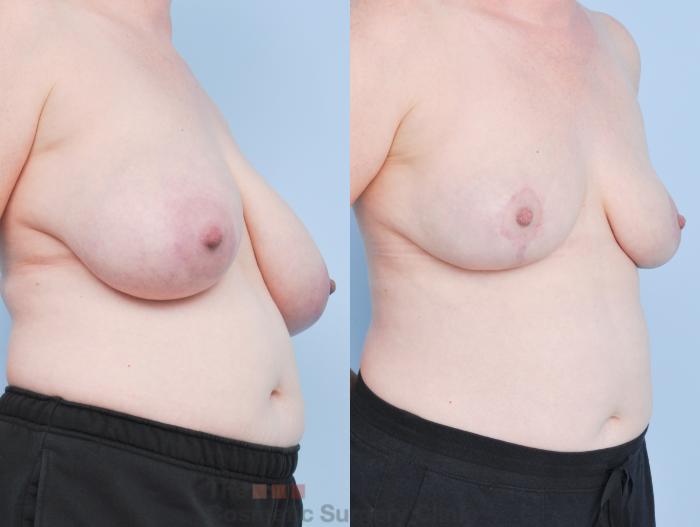 Before & After Breast Lift Case 920 Right Oblique View in Waterloo, Ontario