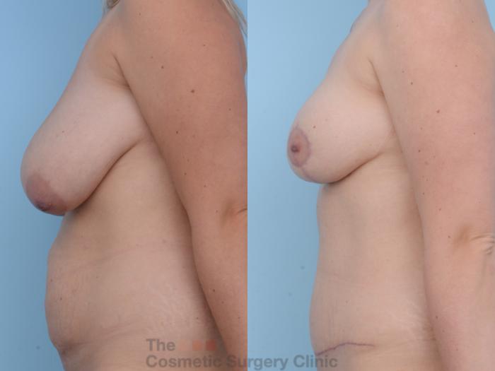 Before & After Breast Reduction Case 280 View #2 View in Waterloo, Ontario
